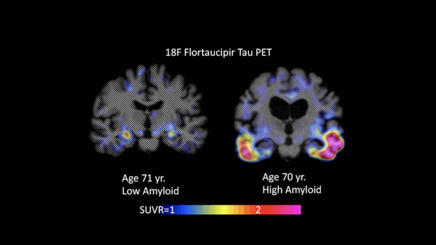 Figure 1. Flortaucipir images with low (Braak I/II) and high (Braak III/VI) levels of tau. The individual whose image is shown on the left had low amyloid levels; the one shown on the right had high amyloid levels (images courtesy of Keith Johnson) 